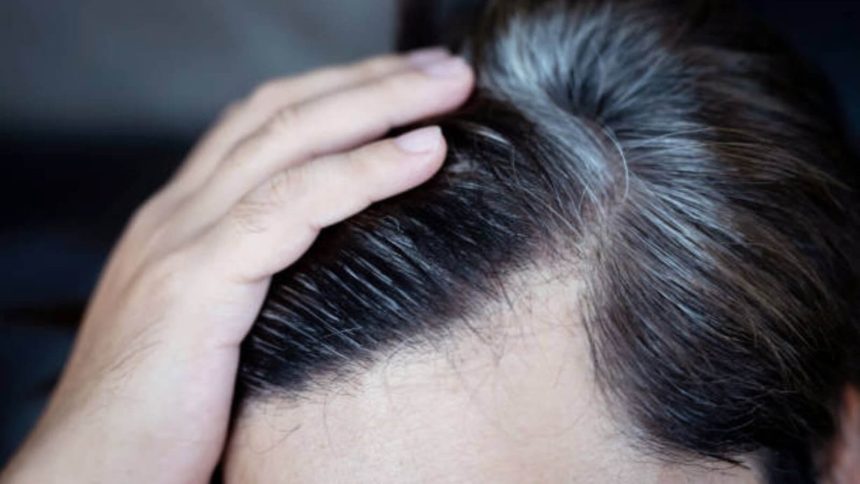 Know the Causes of White Hair and Easy Ways to Prevent It Naturally